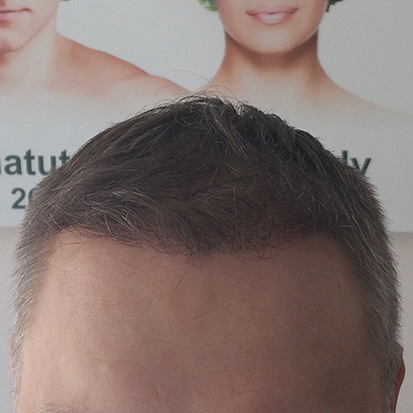 Matu transplantācija pēc foto #3