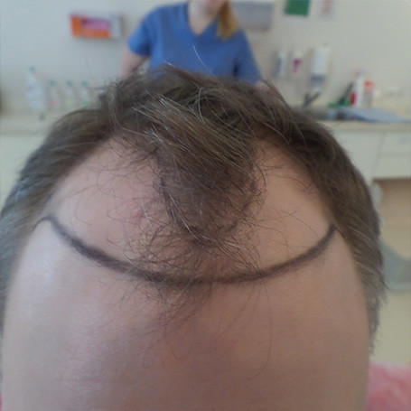 Matu transplantācija pirms foto #3