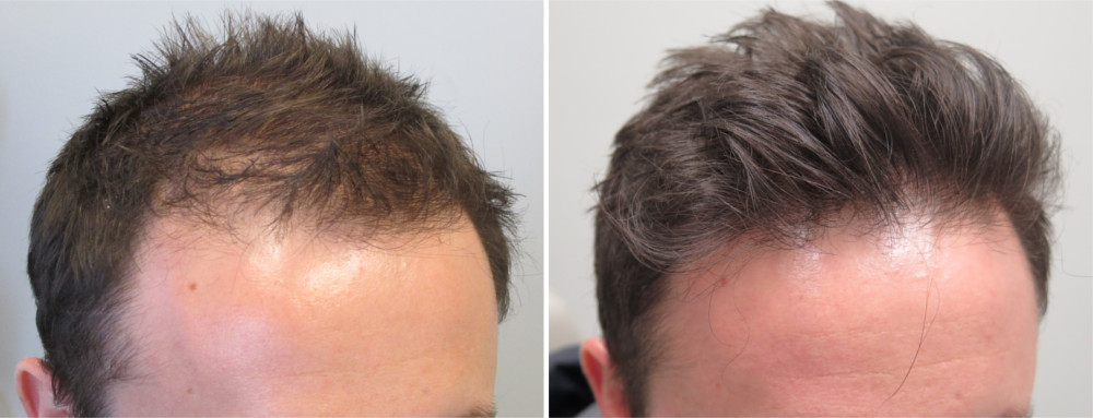 Minoxidil 5% matu augšanai